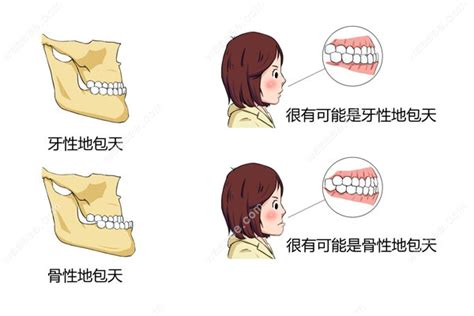 地包|你了解地包天吗？